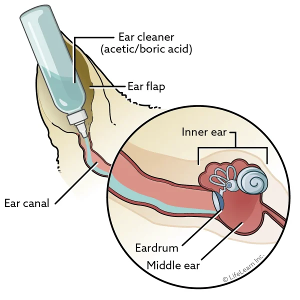 Acetic Acid Boric Acid Otic