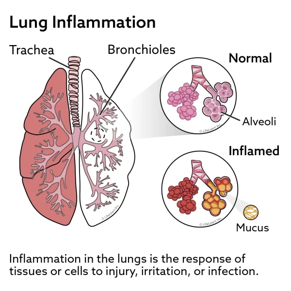 Acute Respiratory Distress Syndrome (Shock Lung) in Catsd