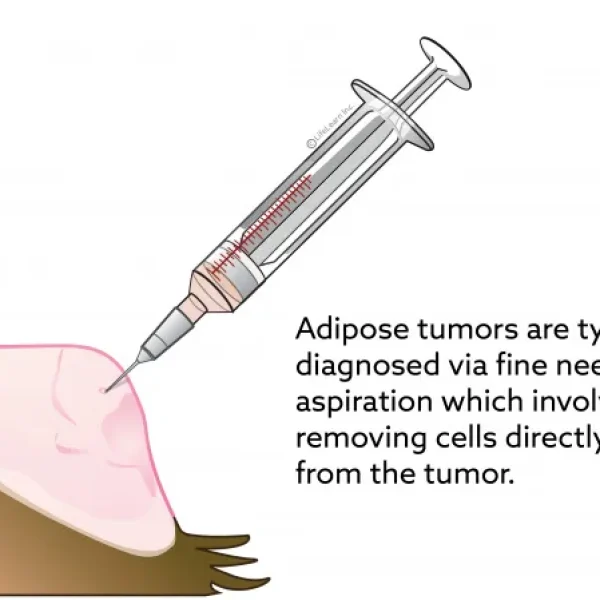 Adipose (Lipoma) Tumors