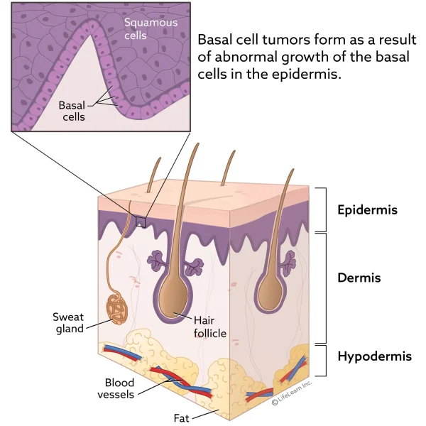 Basal Cell Tumors