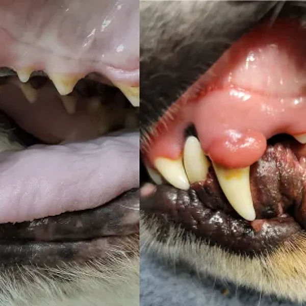 Gingival Hyperplasia