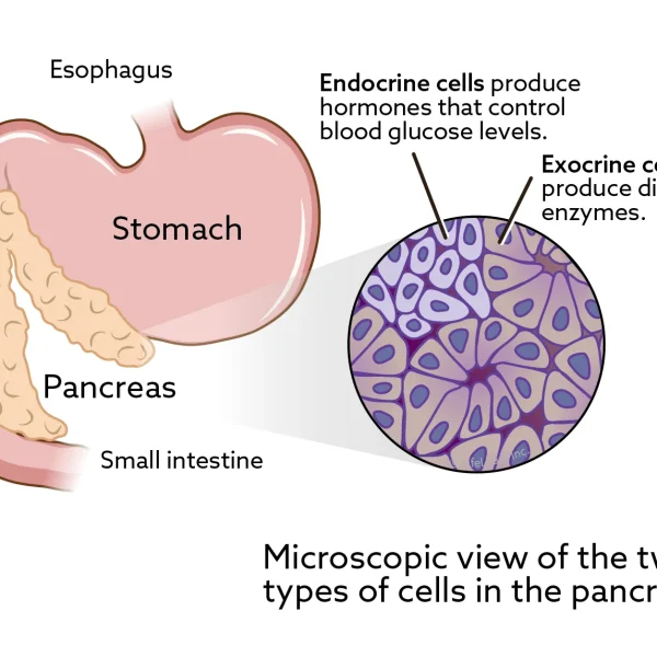 Pancreatic Tumors