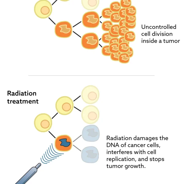 Radiation Therapy
