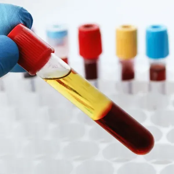 Serum Protein Electrophoresis
